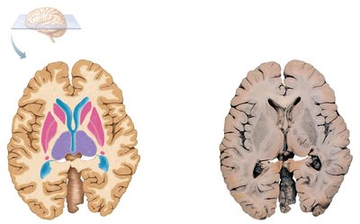 Horizontal section showing cortex, basal ganglia, and white matter