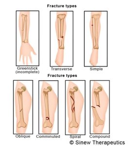 Types of bone fractures