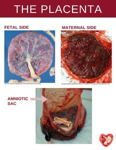 Fetal and maternal sides of the placenta