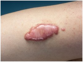 Keloid: raised scar tissue
