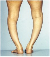 Rickets: bone deformity due to vitamin D3 deficiency
