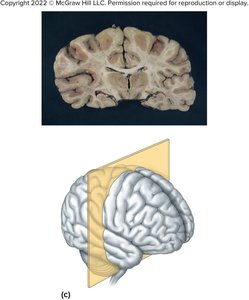 Coronal section of the brain