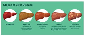 Stages of liver disease