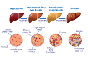 Stages and cellular changes in liver disease