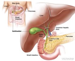 Gallstones and bile duct obstruction