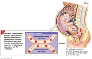 HDN: First pregnancy, Rh- mother and Rh+ fetus