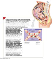 HDN: Second pregnancy, maternal antibodies attack fetal RBCs