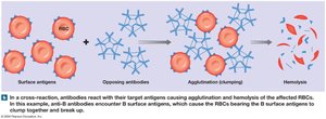 Transfusion reaction: agglutination and hemolysis