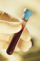 Blood sample in test tube