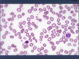 Anemia blood smear