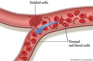 Sickled cells blocking blood vessels