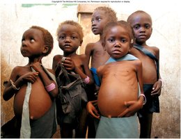 Children with kwashiorkor showing edema