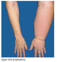 Upper limb lymphedema