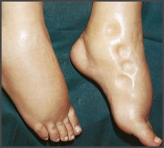 Pitting edema in foot