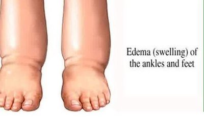 Edema of the ankles and feet