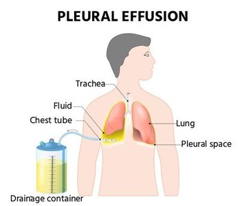 Pleural effusion diagram