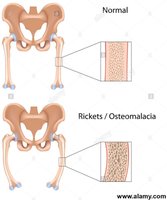 Normal vs. rickets/osteomalacia bone structure