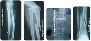Types of bone fractures: transverse, displaced, compression, spiral