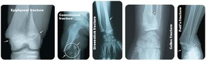 More types of bone fractures: epiphyseal, comminuted, greenstick, Colles, Pott's