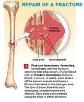 Step 1: Fracture hematoma formation