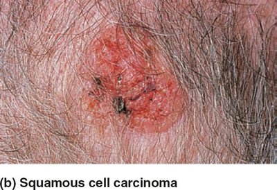 Squamous cell carcinoma