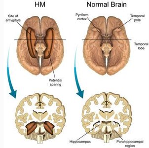 Brain regions affected in H.M. and normal brain