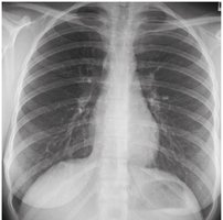 Chest X-ray