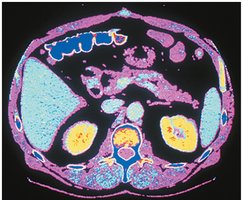 CT scan of abdominopelvic cavity