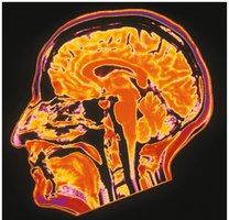 MRI of brain
