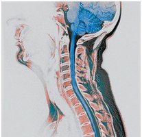 MRI of vertebral cavity