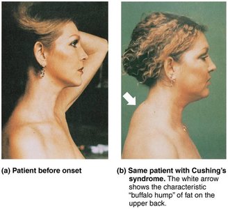 Effects of excess glucocorticoid