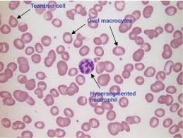 Blood smear showing macrocytes and hypersegmented neutrophils in pernicious anemia