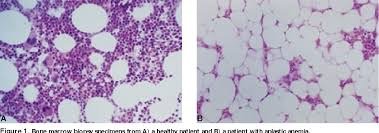 Normal vs. aplastic bone marrow
