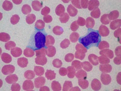 Blood smear showing atypical lymphocytes in mononucleosis