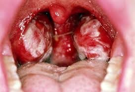 Tonsils with pus in mononucleosis