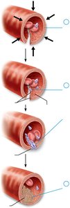 Steps of hemostasis
