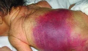 Hematoma in hemophilia