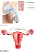 Permanent methods of birth control