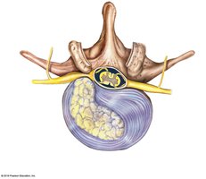 Herniated intervertebral disc