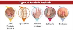 Types of psoriatic arthritis