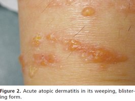 Acute atopic dermatitis: weeping, blistering lesions