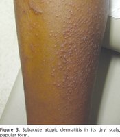 Subacute atopic dermatitis: dry, scaly papular lesions