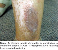 Chronic atopic dermatitis: lichenified plaque with depigmentation