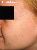 Mild acne: papules and comedones
