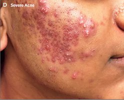 Moderate acne: more numerous papules and pustules