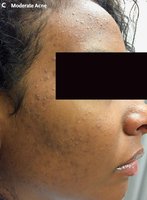 Severe acne: nodules and cysts