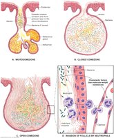 Pathogenesis of acne: comedone formation and inflammation