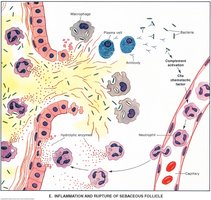 Inflammation and rupture of sebaceous follicle in acne