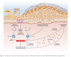 Pathogenesis of psoriasis: immune activation and keratinocyte proliferation