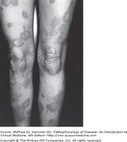 Plaque psoriasis lesions on knees